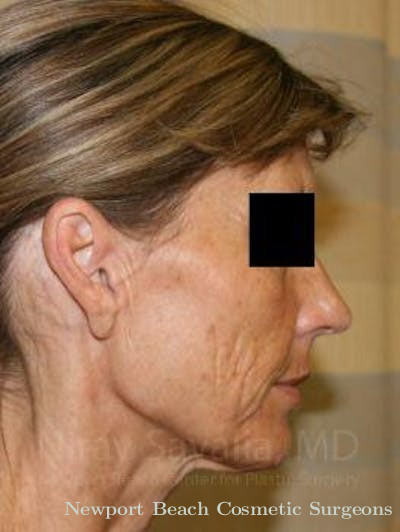 Fat Grafting to Face Before & After Gallery - Patient 1655704 - Before