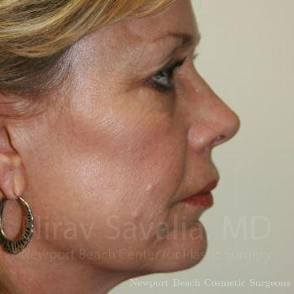 Chin Implants Before & After Gallery - Patient 1655706 - Before