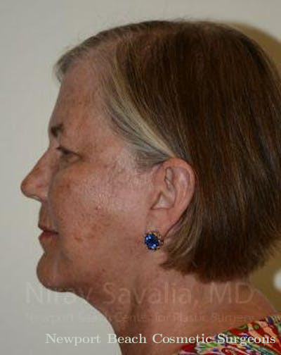 Torn Earlobe Repair Ear Gauge Repair Before & After Gallery - Patient 1655705 - After