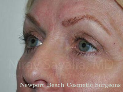 Facelift Before & After Gallery - Patient 1655707 - After