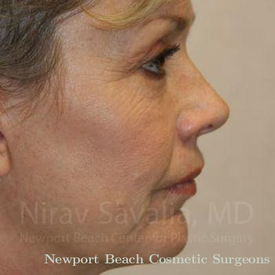 Facelift Before & After Gallery - Patient 1655706 - After