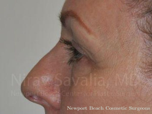 Fat Grafting to Face Before & After Gallery - Patient 1655707 - Before