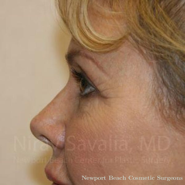 Breast Explantation En Bloc Capsulectomy Before & After Gallery - Patient 1655706 - Before