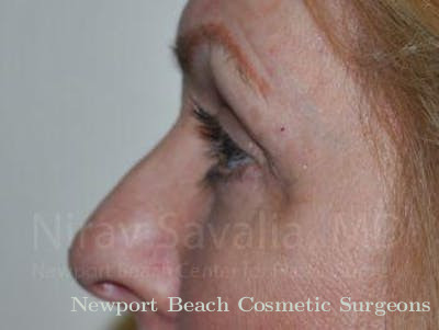 Brow Lift Before & After Gallery - Patient 1655707 - After