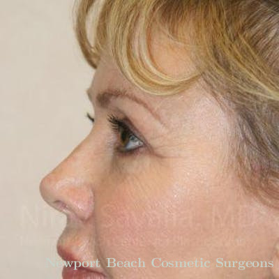 Mastectomy Reconstruction Revision Before & After Gallery - Patient 1655706 - After