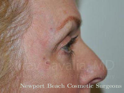 Mommy Makeover Before & After Gallery - Patient 1655707 - After