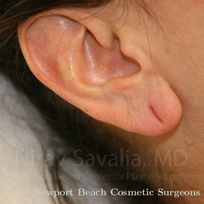 Torn Earlobe Repair Ear Gauge Repair Before & After Gallery - Patient 1655708 - Before