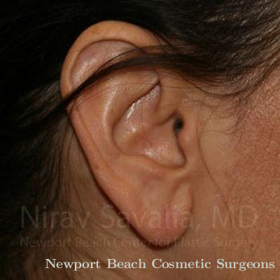Torn Earlobe Repair Ear Gauge Repair Before & After Gallery - Patient 1655708 - After