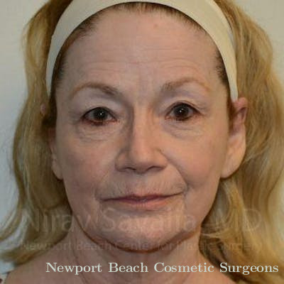 Fat Grafting to Face Before & After Gallery - Patient 1655710 - Before