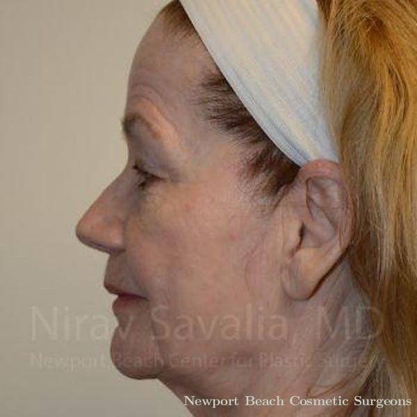 Facelift Before & After Gallery - Patient 1655710 - Before