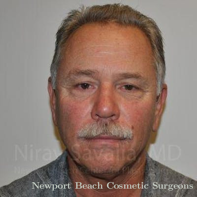 Facelift Before & After Gallery - Patient 1655711 - Before