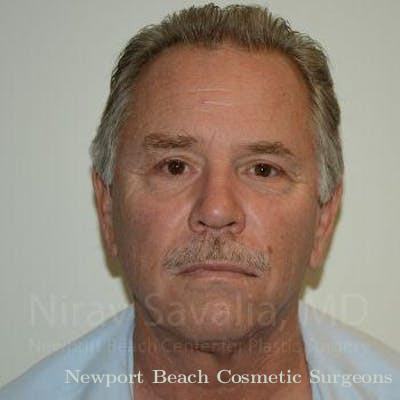 Chin Implants Before & After Gallery - Patient 1655711 - After