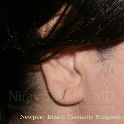 Torn Earlobe Repair Ear Gauge Repair Before & After Gallery - Patient 1655709 - Before