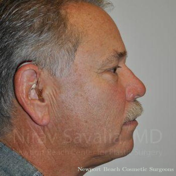 Torn Earlobe Repair Ear Gauge Repair Before & After Gallery - Patient 1655711 - Before