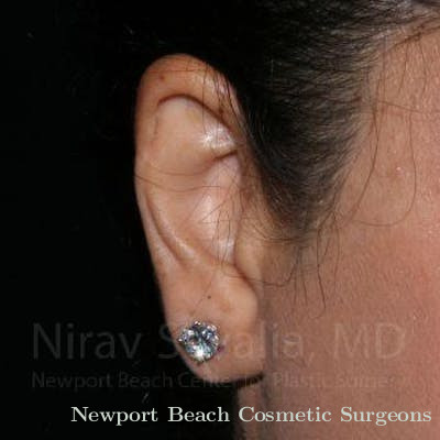 Torn Earlobe Repair Ear Gauge Repair Before & After Gallery - Patient 1655709 - After