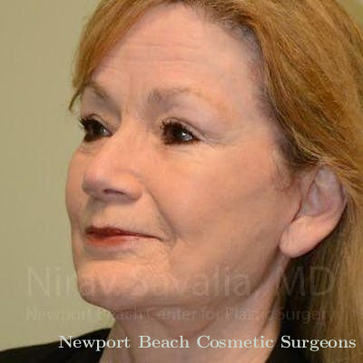 Facelift Before & After Gallery - Patient 1655710 - After