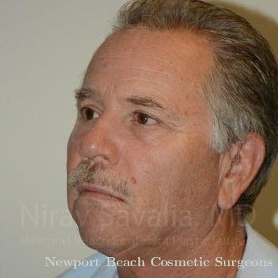Oncoplastic Reconstruction Before & After Gallery - Patient 1655711 - After