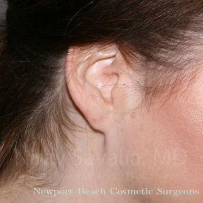Oncoplastic Reconstruction Before & After Gallery - Patient 1655713 - After