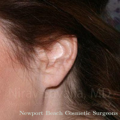 Facelift Before & After Gallery - Patient 1655713 - After
