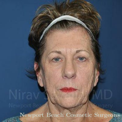 Facelift Before & After Gallery - Patient 1655716 - Before