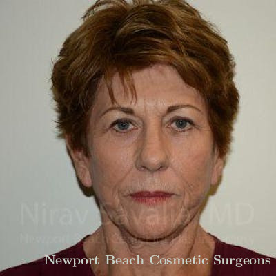 Brow Lift Before & After Gallery - Patient 1655716 - After