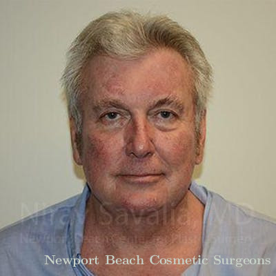 Facelift Before & After Gallery - Patient 1655717 - After