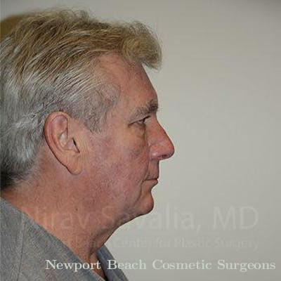 Male Breast Reduction Before & After Gallery - Patient 1655717 - Before