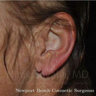 Torn Earlobe Repair Ear Gauge Repair Before & After Gallery - Patient 1655715 - Before