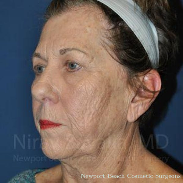 Facelift Before & After Gallery - Patient 1655716 - Before