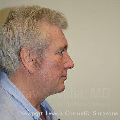 Facelift Before & After Gallery - Patient 1655717 - After