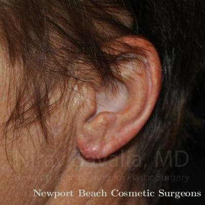 Torn Earlobe Repair Ear Gauge Repair Before & After Gallery - Patient 1655715 - After