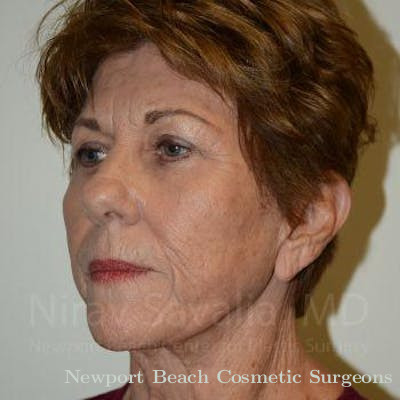 Facelift Before & After Gallery - Patient 1655716 - After