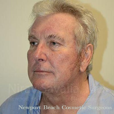 Eyelid Surgery Before & After Gallery - Patient 1655717 - After