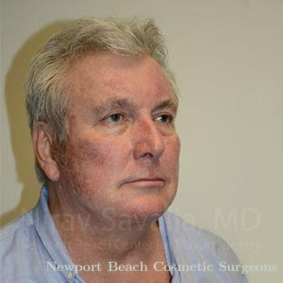 Mastectomy Reconstruction Before & After Gallery - Patient 1655717 - After