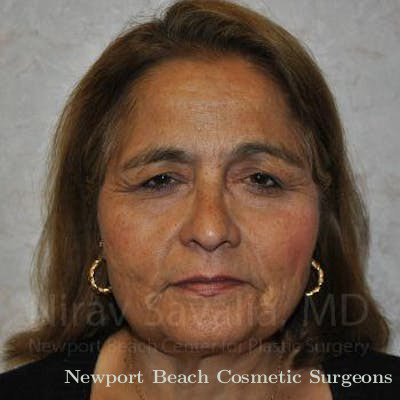 Fat Grafting to Face Before & After Gallery - Patient 1655719 - Before