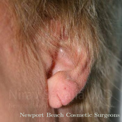 Facelift Before & After Gallery - Patient 1655718 - Before