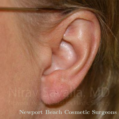 Torn Earlobe Repair Ear Gauge Repair Before & After Gallery - Patient 1655718 - After
