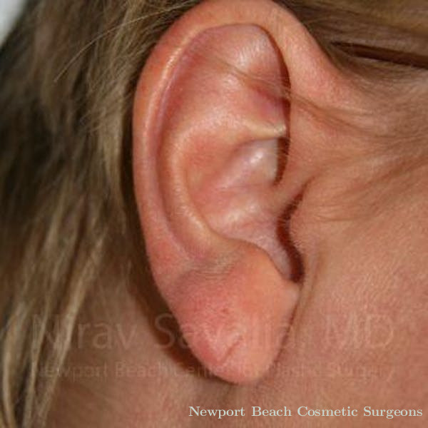Torn Earlobe Repair Ear Gauge Repair Before & After Gallery - Patient 1655718 - Before