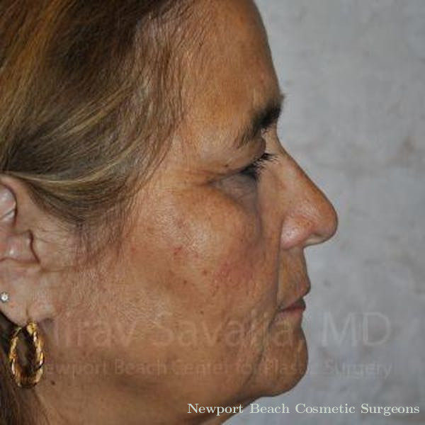 Torn Earlobe Repair Ear Gauge Repair Before & After Gallery - Patient 1655719 - Before