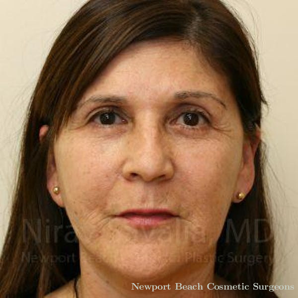 Oncoplastic Reconstruction Before & After Gallery - Patient 1655721 - Before