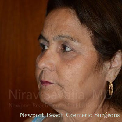 Oncoplastic Reconstruction Before & After Gallery - Patient 1655719 - After