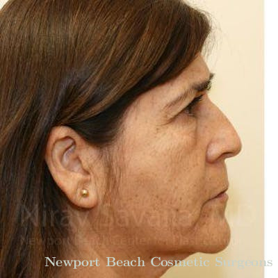 Chin Implants Before & After Gallery - Patient 1655721 - Before