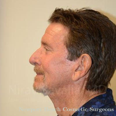 Facelift Before & After Gallery - Patient 1655720 - After