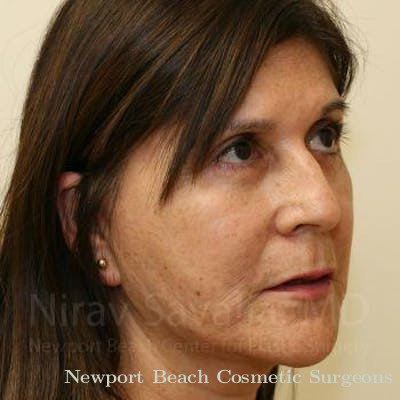 Fat Grafting to Face Before & After Gallery - Patient 1655721 - After