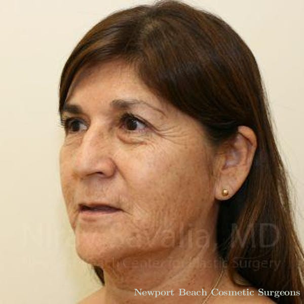 Facelift Before & After Gallery - Patient 1655721 - Before
