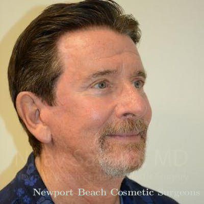 Chin Implants Before & After Gallery - Patient 1655720 - After