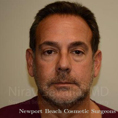Fat Grafting to Face Before & After Gallery - Patient 1655723 - Before