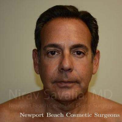 Eyelid Surgery Before & After Gallery - Patient 1655723 - After