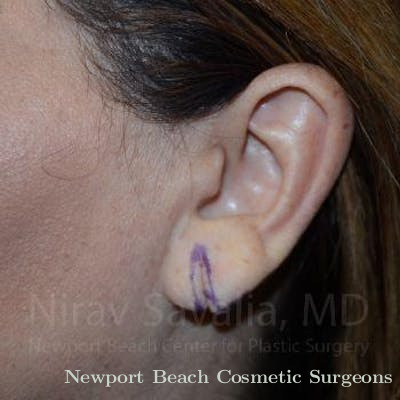 Torn Earlobe Repair Ear Gauge Repair Before & After Gallery - Patient 1655724 - Before