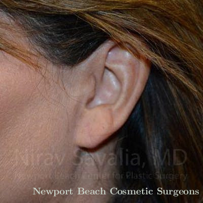 Torn Earlobe Repair Ear Gauge Repair Before & After Gallery - Patient 1655724 - After